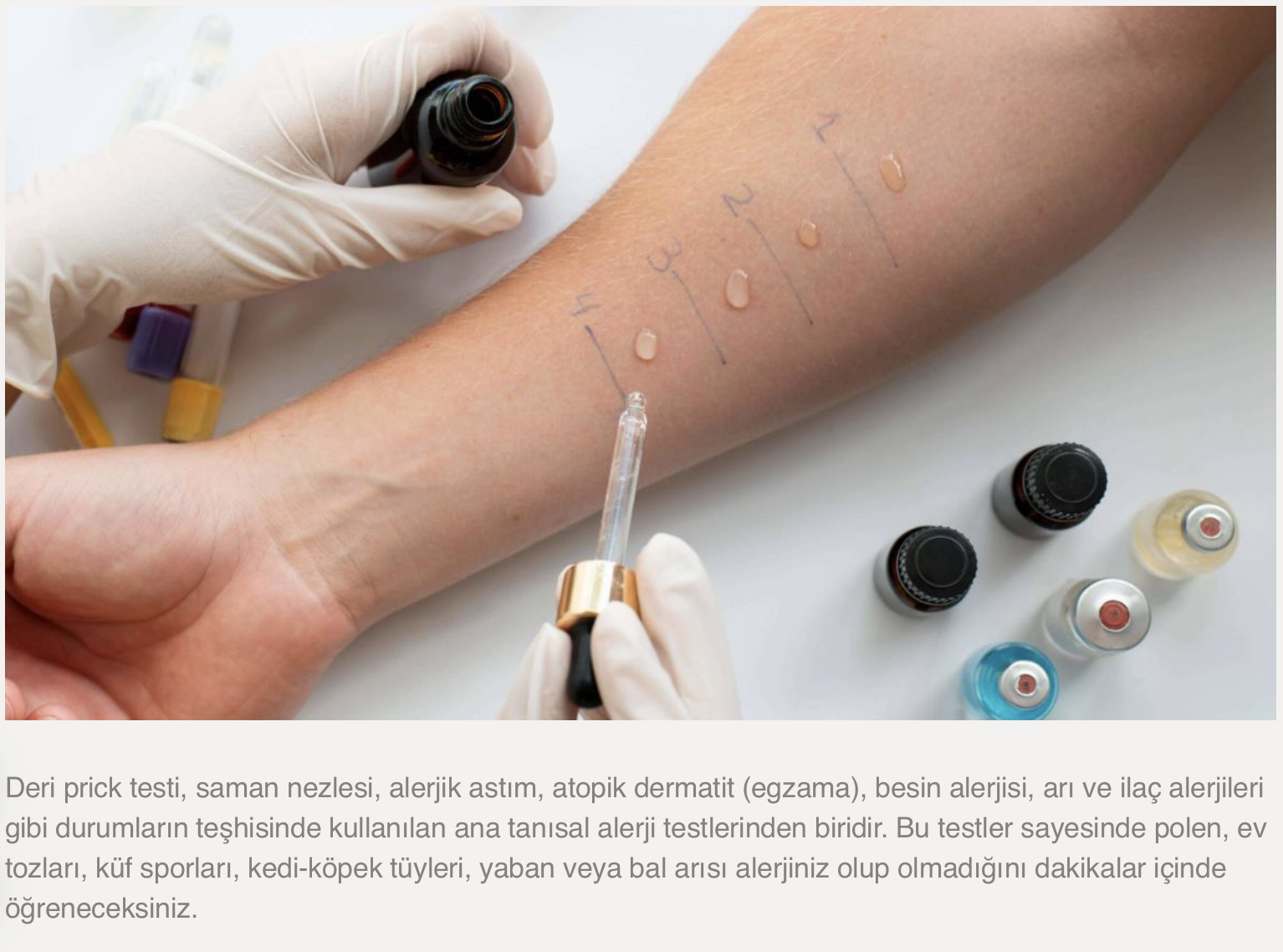 Alerji deri testi ve immünoterapi hazırlığı